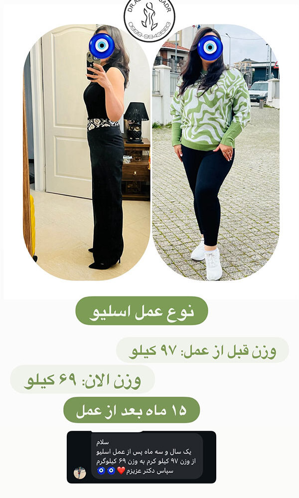 افرادی که عمل چاقی کرده اند قبل و بعد