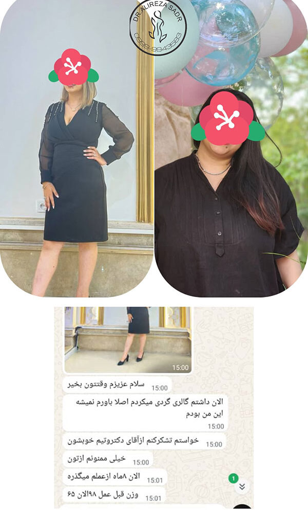 افرادی که عمل چاقی کرده اند قبل و بعد