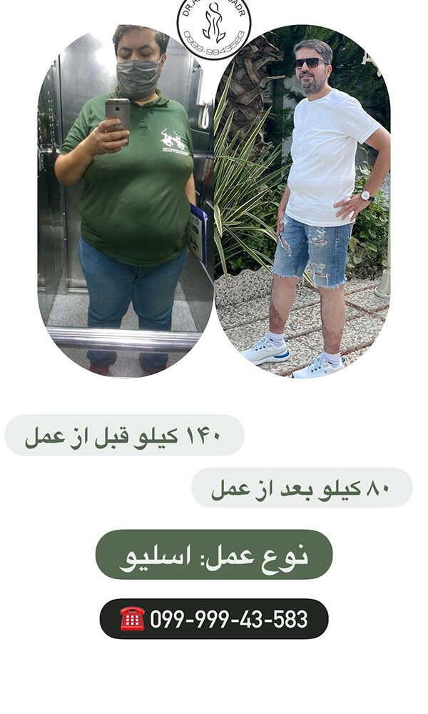 افرادی که عمل چاقی کرده اند قبل و بعد
