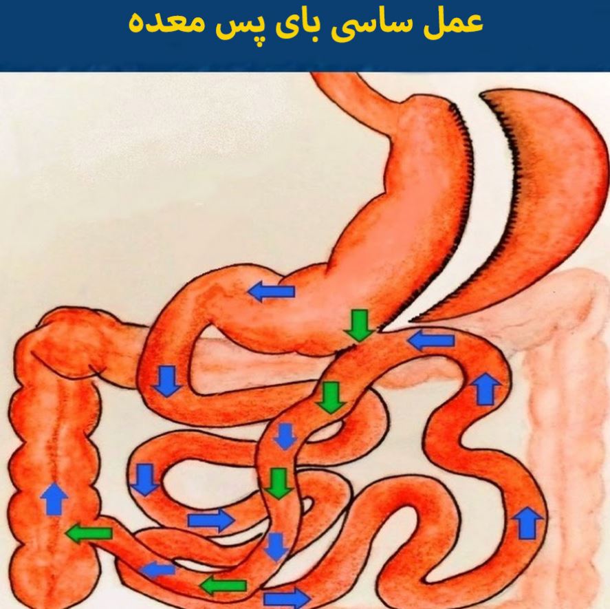 ساسج بای پس